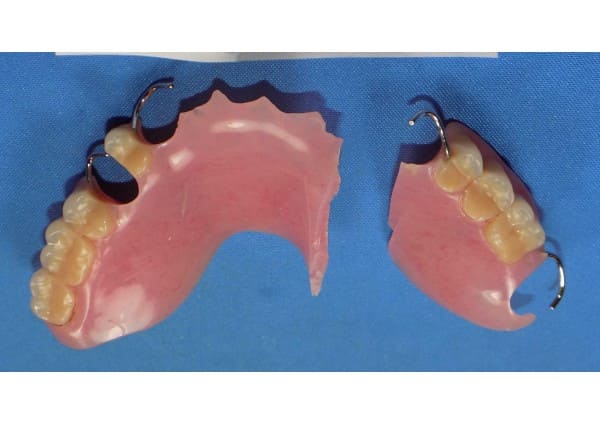 Broken upper partial denture