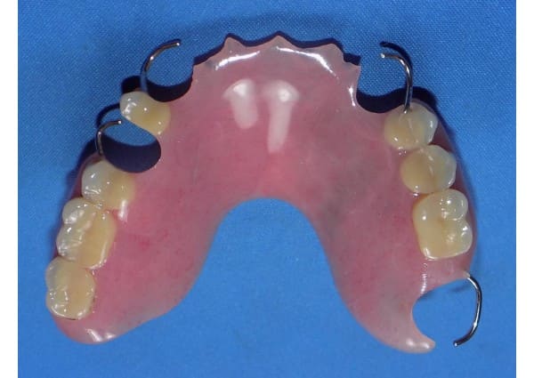 Repaired upper partial denture