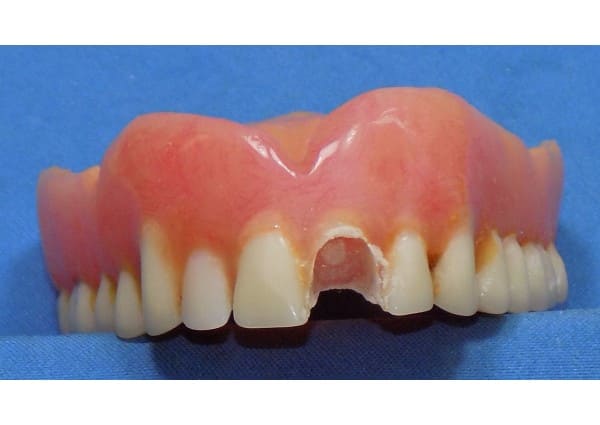 Missing denture tooth
