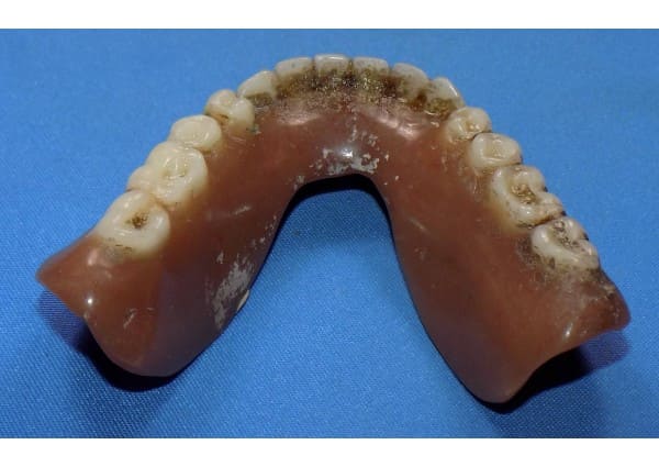 Stained lower denture